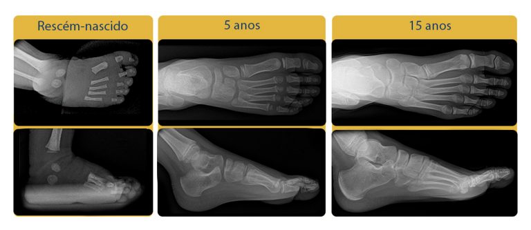 Até Que Idade O Pé Cresce Emenda O Crescimento Dos Pés Das Crianças